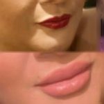 BOTOX AND DERMAL FILLERS