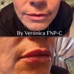 BOTOX AND DERMAL FILLERS
