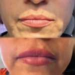 BOTOX AND DERMAL FILLERS