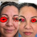BOTOX AND DERMAL FILLERS