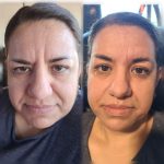 BOTOX AND DERMAL FILLERS