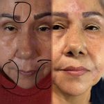 BOTOX AND DERMAL FILLERS
