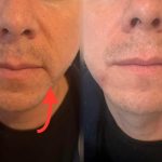 BOTOX AND DERMAL FILLERS