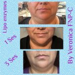 LIPO ENZYMES