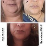 LIPO ENZYMES