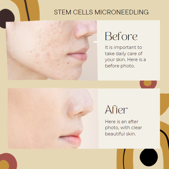 STEM CELLS MICRONEEDLING