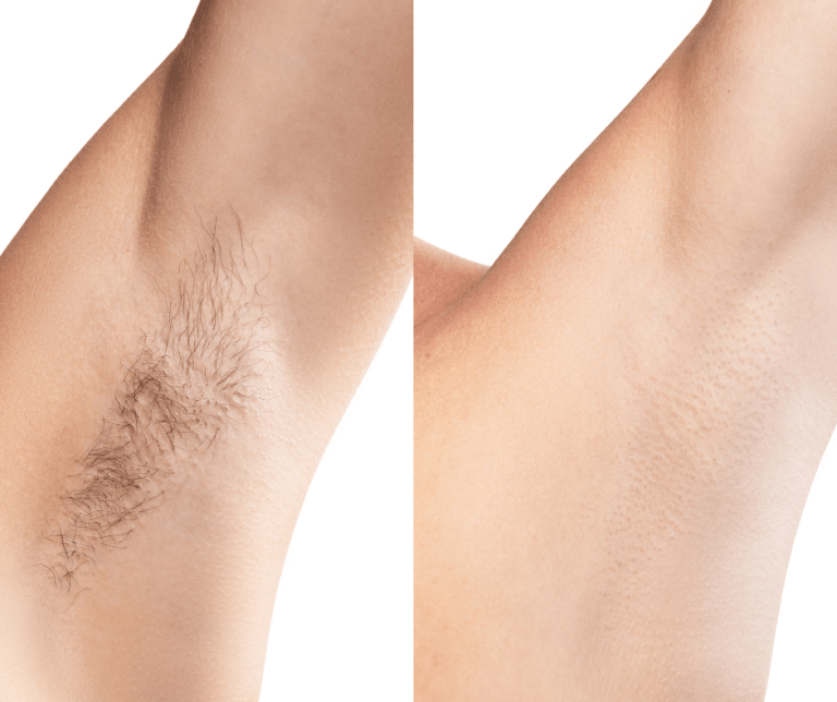 ARMPIT LASER HAIR REMOVAL