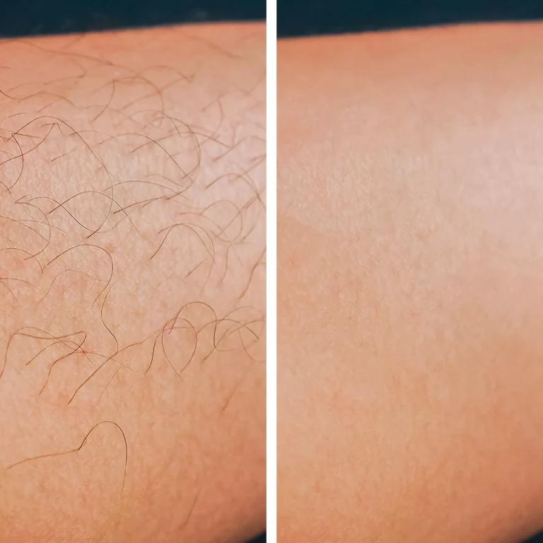 LASER LEG HAIR REMOVAL